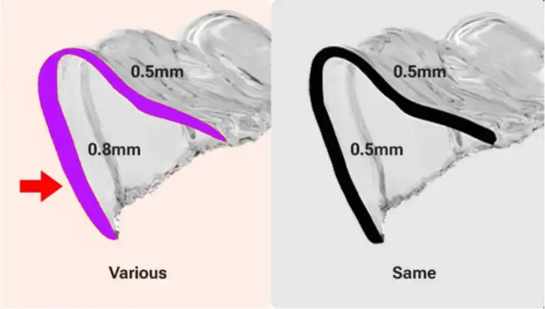 Soleir’s illustration of multi-thickness aligner design